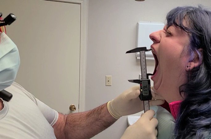 Doctor opens woman's mouth with calipers