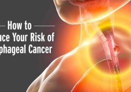 ‘First’ Symptom Of Oesophageal Cancer – And How To Reduce Your Risk (BREAKING)