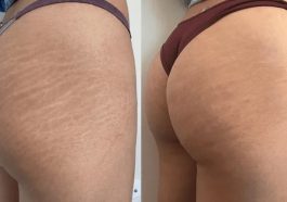 Stretch Mark Camouflage: How It Works & Why To Try It
