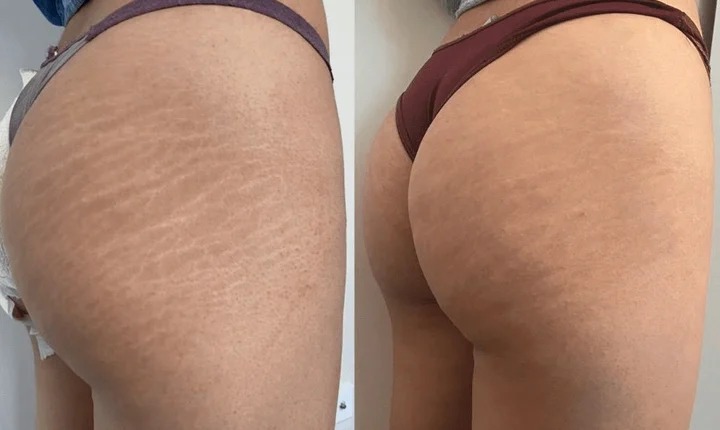 Stretch Mark Camouflage: How It Works & Why To Try It Stretch Mark Camouflage: How It Works & Why To Try It