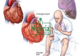 Protect Your Heart From Heart Failure By Avoiding Too Much Intake Of These Three Things JUST IN:
