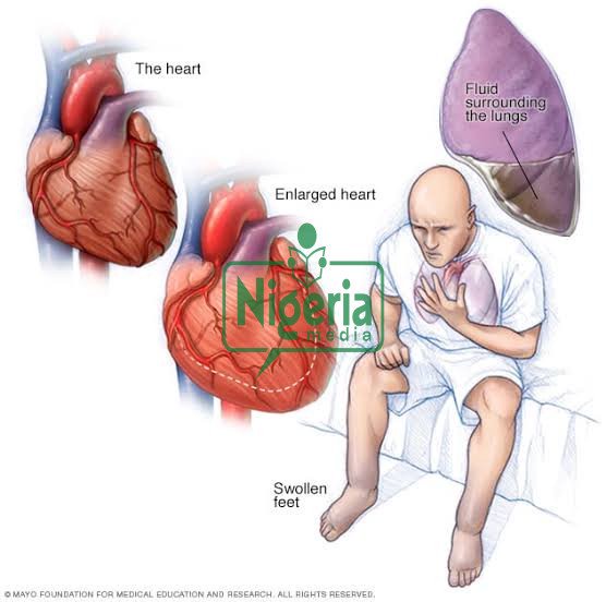 Protect Your Heart From Heart Failure By Avoiding Too Much Intake Of These Three Things JUST IN:
