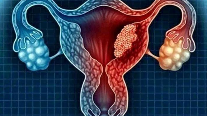 Uterine Cancer: Stay Away From These 4 (Four) Things To Avoid The Risk Of Being A Victim Uterine Cancer: Stay Away From These 4 (Four) Things To Avoid The Risk Of Being A Victim