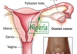 JUST IN: Causes And Signs Of Ovarian Cancer