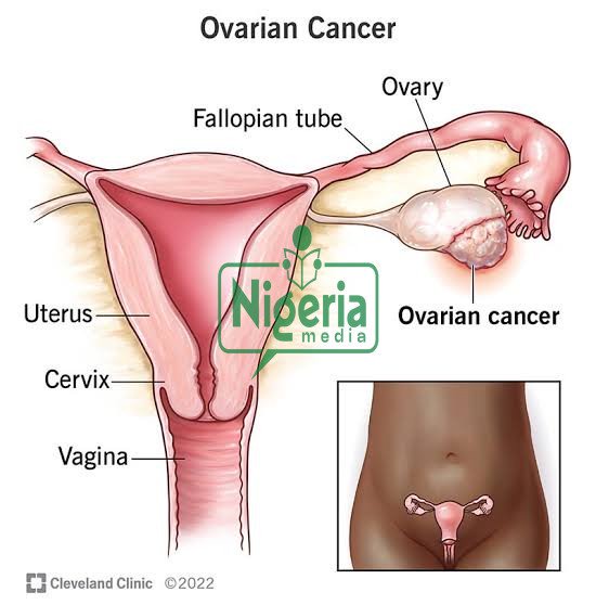 JUST IN: Causes And Signs Of Ovarian Cancer JUST IN: Causes And Signs Of Ovarian Cancer