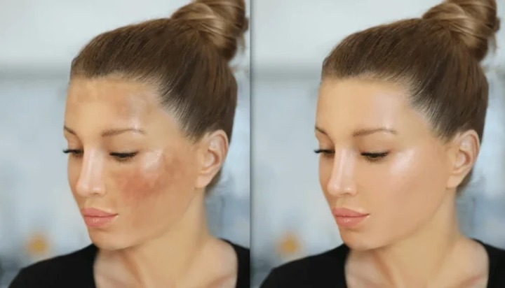 When Your Face Has Dark Spots, Use Following For Smooth Spotless Skin
