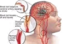 JUST IN: If You Don’t Want To Suffer Stroke At Old Age, Avoid Excess Intake Of These three Things