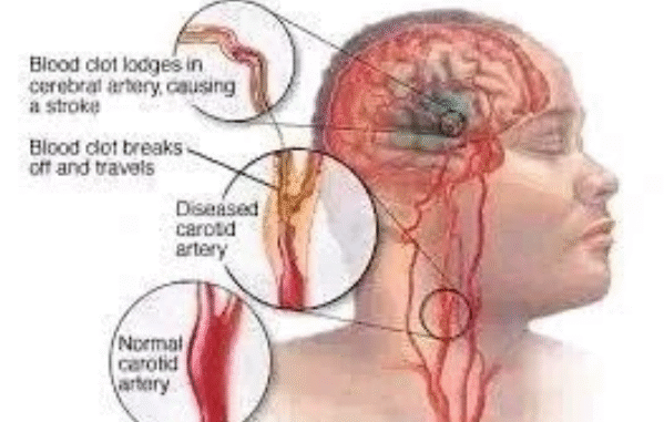 JUST IN: If You Don’t Want To Suffer Stroke At Old Age, Avoid Excess Intake Of These three Things JUST IN: If You Don’t Want To Suffer Stroke At Old Age, Avoid Excess Intake Of These three Things