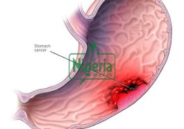 Cancer Of The Stomach Kills, Stop Eating These Three Things. If You Want To Live Long (