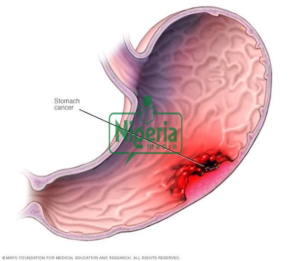 Cancer Of The Stomach Kills, Stop Eating These Three Things. If You Want To Live Long ( Cancer Of The Stomach Kills, Stop Eating These Three Things. If You Want To Live Long (
