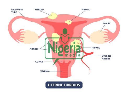 Ten Common Uterine Diseases Every Woman Should Know