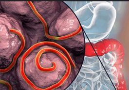 JUST IN: Foods That Naturally Remove Worms From the Stomach
