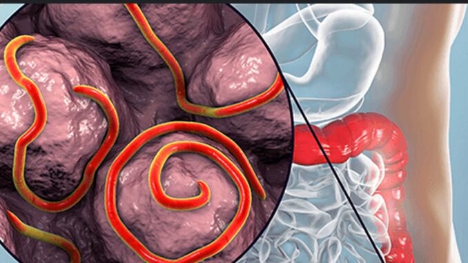 JUST IN: Foods That Naturally Remove Worms From the Stomach JUST IN: Foods That Naturally Remove Worms From the Stomach