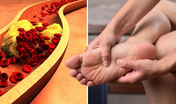 The ‘Silent’ Symptom Of Dangerously High Cholesterol That Shows On Your TOES – And 3 Other Signs