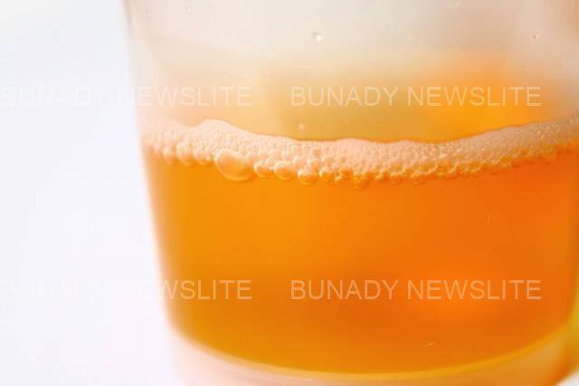 Foamy Urine: If Your Urine Always Foams, Here Are It’s 5 Possible Causes And Foods To Watch Out For Foamy Urine: If Your Urine Always Foams, Here Are It’s 5 Possible Causes And Foods To Watch Out For