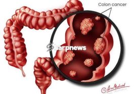 Cancer Of The Intestine Kills Fast: Avoid Too Much Intake Of These 3 Things If You Want To Live Long