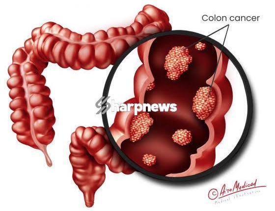 Cancer Of The Intestine Kills Fast: Avoid Too Much Intake Of These 3 Things If You Want To Live Long Cancer Of The Intestine Kills Fast: Avoid Too Much Intake Of These 3 Things If You Want To Live Long