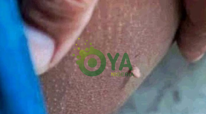 JUST-IN: What These Little Bumps On The Skin Are And How To Take Care Of Them JUST-IN: What These Little Bumps On The Skin Are And How To Take Care Of Them