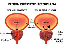 5 Early Warning Signs Of An Enlarged Prostate That Every Man Need To Know