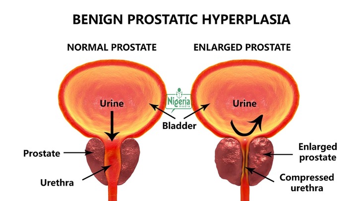 5 Early Warning Signs Of An Enlarged Prostate That Every Man Need To Know 5 Early Warning Signs Of An Enlarged Prostate That Every Man Need To Know