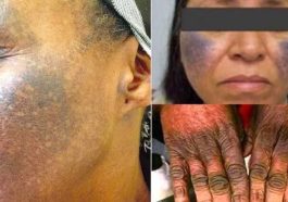 BREAKING: Skin Bleaching Creams & Pills Can Damage Your Kidney & Liver Permanently!