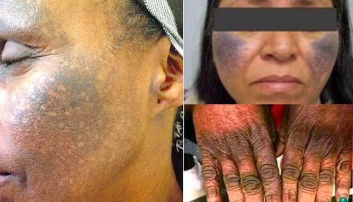 BREAKING: Skin Bleaching Creams & Pills Can Damage Your Kidney & Liver Permanently! BREAKING: Skin Bleaching Creams & Pills Can Damage Your Kidney & Liver Permanently!